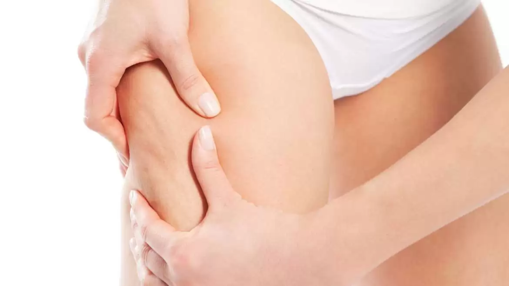Gros plan d'une main compressant une cuisse pour mettre en évidence de la cellulite.