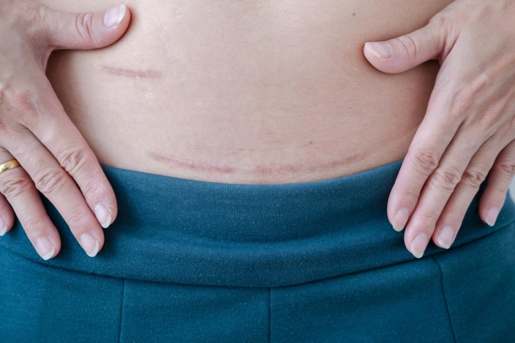 Gros plan sur cicatrice de césarienne